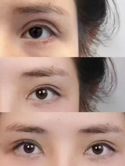 上海马娟和卢玲两位医生哪个修复眼睛好？马娟和卢玲双眼皮修复怎么选？