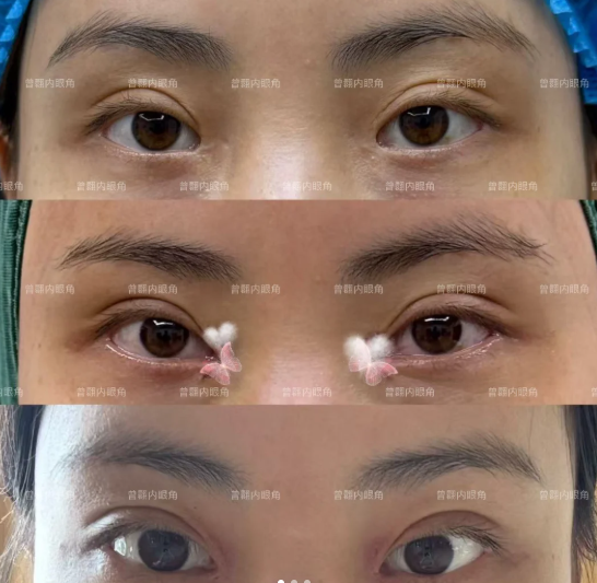 上海曾翾和马娟医生哪个做眼修复技术好？眼修复曾翾和马娟谁更厉害？
