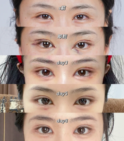 上海杨海平和马娟两个医生做眼修复哪个好？杨海平和马娟双眼皮修复案例预约