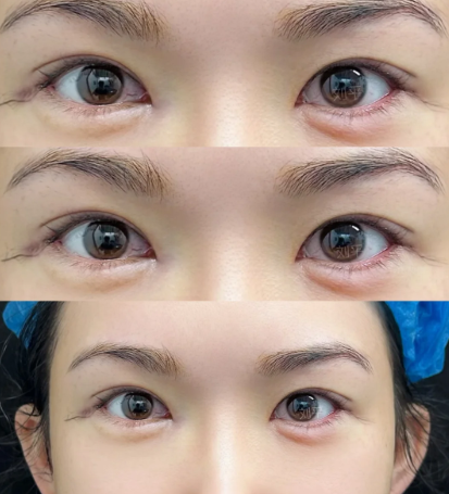 上海刘平和马娟医生哪个做眼修复技术好？刘平和马娟做眼修复案例对比