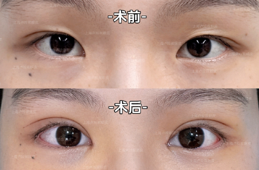 上海双眼皮修复医生卢玲和杨海平哪个修复双眼皮好？