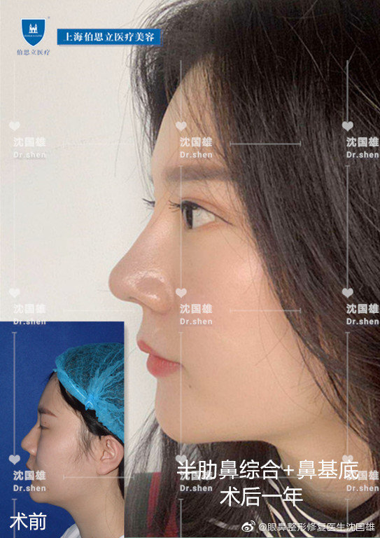 上海沈国雄鼻综合好还是谢卫国好？