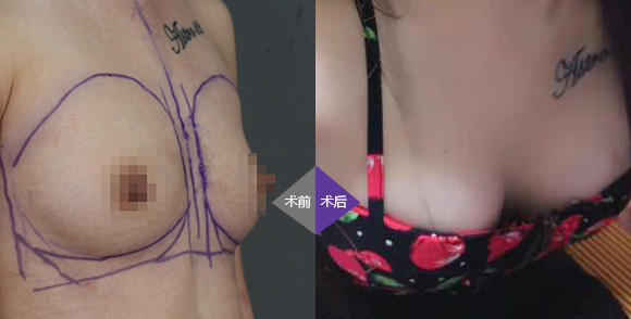 钟波_福州台江整形医院胸部专家