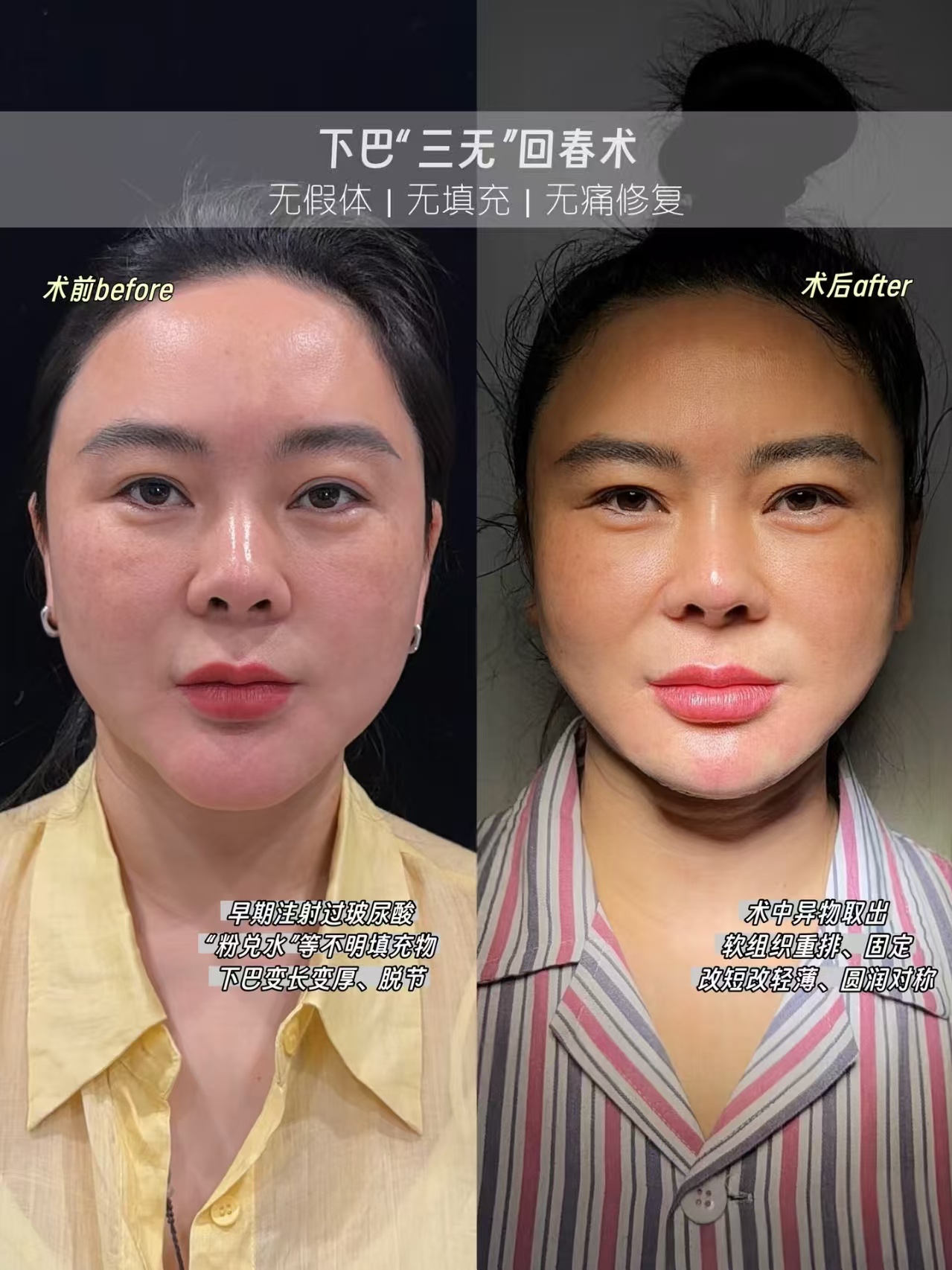 全国异物取出知名专家都有哪些？取生长因子、奥美定、不明注射物十大医生预约排行榜大全