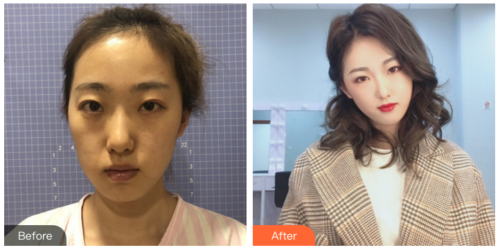 南京面部脂肪填充哪个医生最好