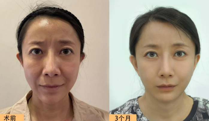北京面部拉皮手术哪个医生做得最好？赵延勇、杜太超、王春虎、袁强谁做提升好？