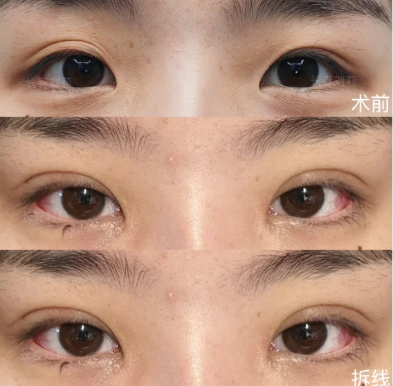长春割双眼皮专家刘莉和宋斌哪个医生口碑和技术更好？