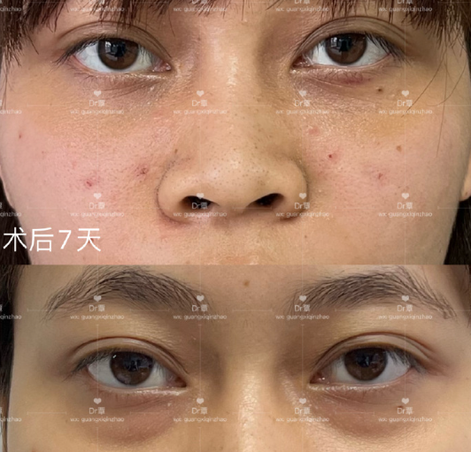 南宁做祛眼袋专家覃朝和蒙旭昌哪个医生去眼袋比较好？