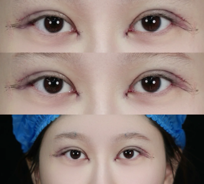 上海马娟和刘平哪个医生做双眼皮修复技术好？马娟和刘平眼修复预约