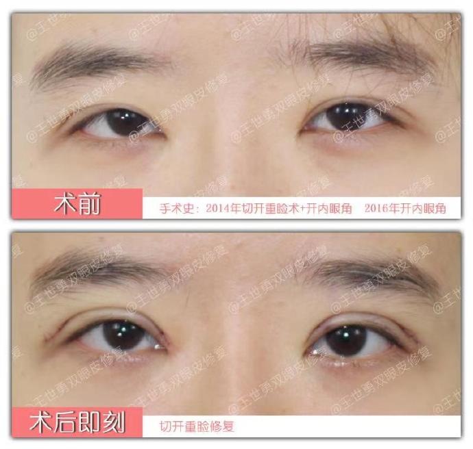 王世勇和白永辉谁做的双眼皮修复最好