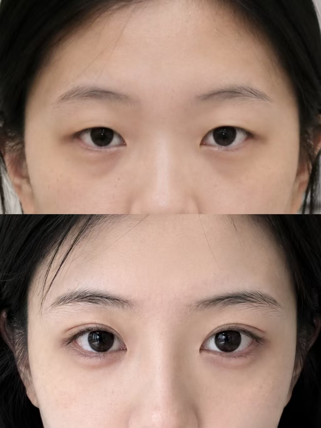 北京做双眼皮比较有名的医生是谁？北京双眼皮医生十大专家预约排行榜大全