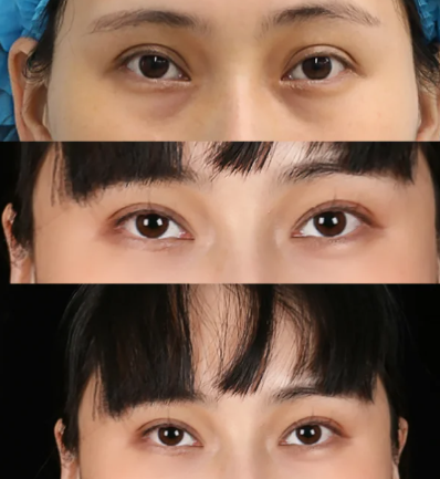 西安双眼皮修复专家陈杰、卢林涛、韩悦、孙峰谁最好？西安双眼皮修复医生预约排行榜