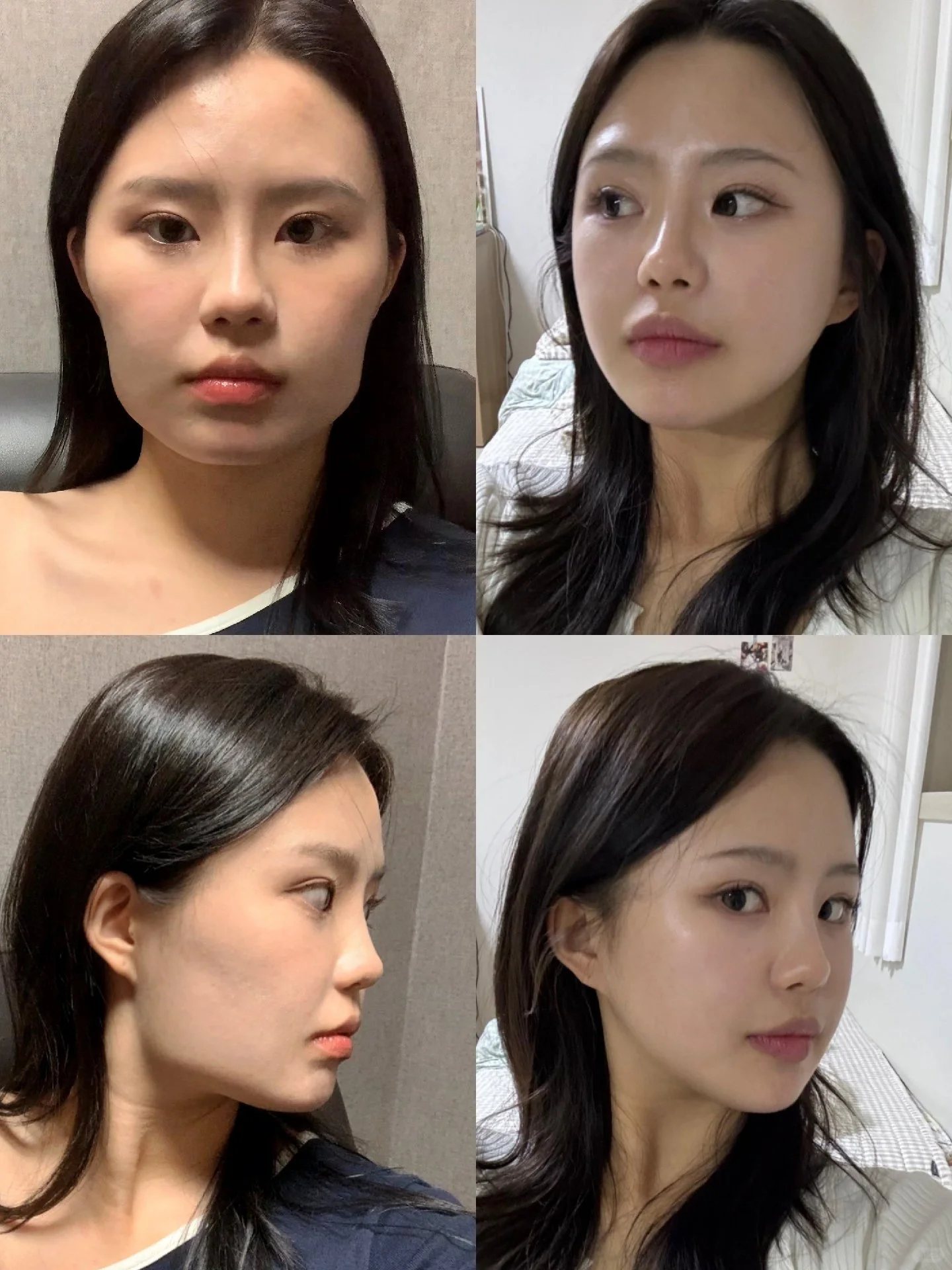 重庆磨骨专家朱乐林和肖林哪个医生做磨骨好？朱乐林和肖林做改脸型吗？